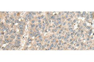 Immunohistochemistry of paraffin-embedded Human liver cancer tissue using CASQ1 Polyclonal Antibody at dilution of 1:100(x200) (Calsequestrin anticorps)