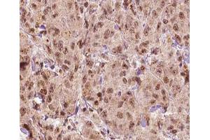 ABIN6266879 at 1/100 staining human Breast carcinoma tissue sections by IHC-P. (MAGEA1 anticorps  (C-Term))
