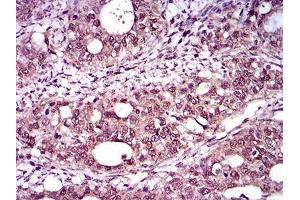Immunohistochemical analysis of paraffin-embedded cervical cancer tissues using T mouse mAb with DAB staining. (T Antigen (AA 257-309) anticorps)