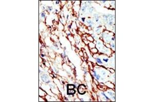 Formalin-fixed and paraffin-embedded human cancer tissue reacted with the primary antibody, which was peroxidase-conjugated to the secondary antibody, followed by AEC staining.
