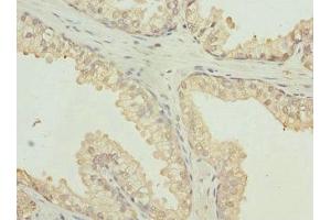 Immunohistochemistry of paraffin-embedded human prostate cancer using ABIN7167501 at dilution of 1:100 (PTPRB anticorps  (AA 1758-1997))