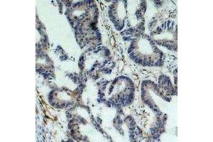 Immunohistochemical analysis of Survivin staining in human colon cancer formalin fixed paraffin embedded tissue section. (Survivin anticorps)