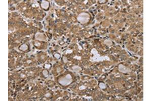 The image on the left is immunohistochemistry of paraffin-embedded Human thyroid cancer tissue using ABIN7192692(STMN2/STMN3/STMN4 Antibody) at dilution 1/45, on the right is treated with synthetic peptide. (STMN2 anticorps)