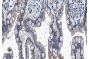 ABIN6266560 at 1/100 staining human colon carcinoma tissue sections by IHC-P. (HDAC7 anticorps  (Internal Region))