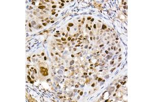 Immunohistochemistry of paraffin-embedded human colon carcinoma using [KO Validated] DNMT1 Rabbit mAb (ABIN7266808) at dilution of 1:100 (40x lens).