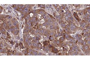 ABIN6277708 at 1/100 staining Human liver cancer tissue by IHC-P. (SLC3A2 anticorps  (Internal Region))