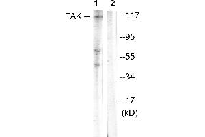 Immunohistochemistry analysis of paraffin-embedded human breast carcinoma tissue using FAK (Ab-397) antibody. (FAK anticorps  (Tyr397))