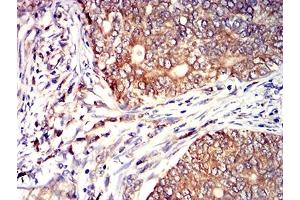 Immunohistochemical analysis of paraffin-embedded cervical cancer tissues using CD53 mouse mAb with DAB staining. (CD53 anticorps)