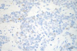 Immunohistochemistry was performed on paraffin-embedded human breast carcinoma using cyclin e2 antibody (ABIN7798199), 1:200). (Recombinant Cyclin E2 anticorps)
