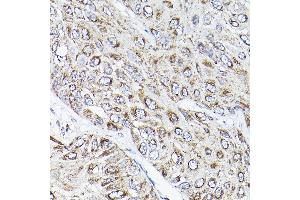 Immunohistochemistry of paraffin-embedded human esophageal cancer using R Rabbit pAb (ABIN3017320, ABIN3017321, ABIN3017322 and ABIN6220039) at dilution of 1:200 (40x lens). (RAMP2 anticorps  (AA 1-145))