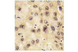 IHC analysis of FFPE human hepatocarcinoma tissue stained with PROX1 antibody (PROX1 anticorps  (AA 185-214))