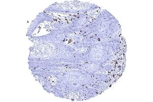 Squamous cell carcinoma containing numerous CD3 positive T lymphocytes