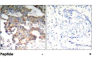 Immunohistochemical analysis of paraffin-embedded human breast carcinoma tissue using NFKBIE polyclonal antibody . (NFKBIE anticorps)