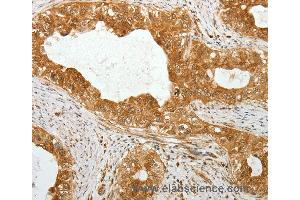 Immunohistochemistry of Human cervical cancer using TEKT1 Polyclonal Antibody at dilution of 1:30 (TEKT1 anticorps)