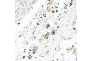 Immunohistochemistry of paraffin-embedded human lung cancer using BTK antibody at dilution of 1:100 (x40 lens). (BTK anticorps)