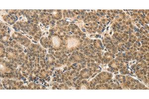 Immunohistochemistry of paraffin-embedded Human thyroid cancer tissue using MAP1A Polyclonal Antibody at dilution 1:40 (MAP1A anticorps)