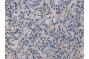 Detection of BMP15 in Human Skin cancer Tissue using Polyclonal Antibody to Bone Morphogenetic Protein 15 (BMP15)