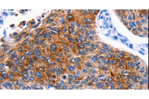 Immunohistochemistry of paraffin-embedded Human lung cancer using DRD4 Polyclonal Antibody at dilution of 1:30 (DRD4 anticorps)