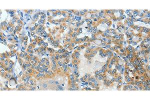 Immunohistochemistry of paraffin-embedded Human thyroid cancer using BAAT Polyclonal Antibody at dilution of 1:30 (BAAT anticorps)