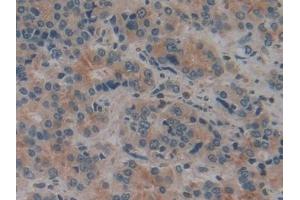 Detection of CYLD in Human Prostate cancer Tissue using Polyclonal Antibody to Cylindromatosis (CYLD)