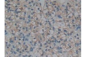 Detection of REN in Human Renal cancer Tissue using Polyclonal Antibody to Renin (REN)