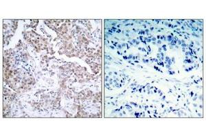 Immunohistochemical analysis of paraffin-embedded human breast carcinoma tissue using p53 (Phospho-Ser15) Antibody (left) or the same antibody preincubated with blocking peptide (right).