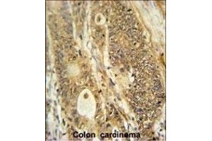 AVIL Antibody (N-term) (ABIN650952 and ABIN2840008) immunohistochemistry analysis in formalin fixed and paraffin embedded human colon carcinoma followed by peroxidase conjugation of the secondary antibody and DAB staining.