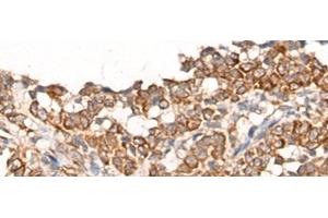 Immunohistochemistry of paraffin-embedded Human ovarian cancer tissue using CA5B Polyclonal Antibody at dilution of 1:65(x200)