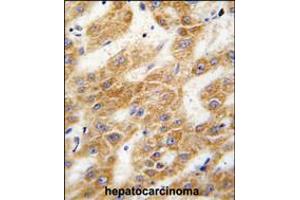 Formalin-fixed and paraffin-embedded human hepatocarcinoma tissue reacted with ALDH4A1 antibody , which was peroxidase-conjugated to the secondary antibody, followed by DAB staining. (ALDH4A1 anticorps  (C-Term))