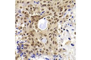 Immunohistochemistry of paraffin-embedded human oophoroma using PHF19 antibody (ABIN5975738) at dilution of 1/100 (40x lens). (PHF19 anticorps)