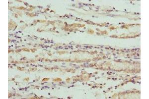 Immunohistochemistry of paraffin-embedded human gastric cancer using ABIN7166101 at dilution of 1:100 (SCO2 anticorps  (AA 1-130))