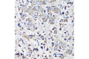 Immunohistochemistry of paraffin-embedded human breast cancer using Cyclin B1 antibody (ABIN7266555) at dilution of 1:100 (40x lens).