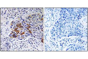 Immunohistochemistry analysis of paraffin-embedded human lung carcinoma tissue, using ADCY9 antibody. (ADCY9 anticorps)