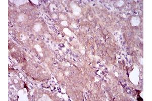 Immunohistochemical analysis of paraffin-embedded cervical cancer tissues using EGFR mutant mouse mAb with DAB staining. (EGFR Mutant (AA 693-893), (Mutant) anticorps)