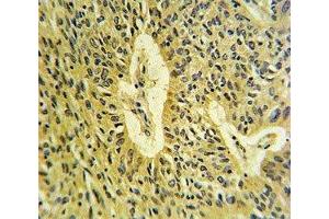 SMAD7 antibody IHC analysis in formalin fixed and paraffin embedded lung carcinoma. (SMAD7 anticorps  (AA 195-224))