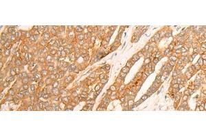 Immunohistochemistry of paraffin-embedded Human liver cancer tissue using DLGAP4 Polyclonal Antibody at dilution of 1:25(x200)