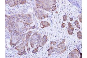 IHC-P Image Immunohistochemical analysis of paraffin-embedded Cal27 xenograft , using Calsequestrin-2, antibody at 1:500 dilution. (CASQ2 anticorps)