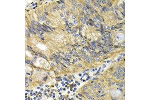 Immunohistochemistry of paraffin-embedded human colon cancer using KLKB1 antibody at dilution of 1:200 (400x lens). (KLKB1 anticorps)