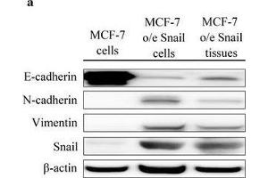 Differential expression of epithelial-mesenchymal transition (EMT) markers in MCF-7 o/e Snail cells and MCF-F o/e Snail tissues. (Vimentin anticorps)