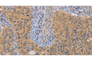 Immunohistochemistry of paraffin-embedded Human cervical cancer using BRS3 Polyclonal Antibody at dilution of 1:50 (BRS3 anticorps)
