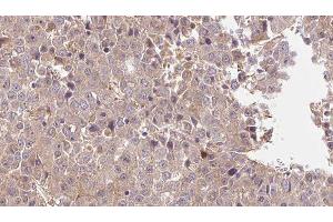 ABIN6275975 at 1/100 staining Human liver cancer tissue by IHC-P. (PTH1R anticorps  (pThr1))