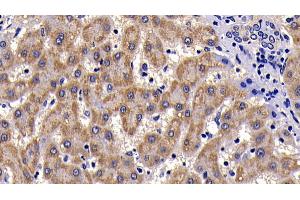 Detection of SAA in Human liver cirrhosis Tissue using Polyclonal Antibody to Serum Amyloid A (SAA)