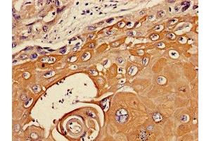 Immunohistochemistry of paraffin-embedded human ovarian cancer using ABIN7174048 at dilution of 1:100 (TIE1 anticorps  (AA 217-328))