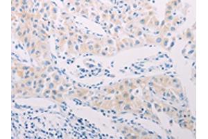 The image on the left is immunohistochemistry of paraffin-embedded Human lung cancer tissue using ABIN7189656(ADAMTS17 Antibody) at dilution 1/60, on the right is treated with synthetic peptide.