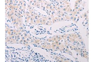 The image on the left is immunohistochemistry of paraffin-embedded Human lung cancer tissue using ABIN7189656(ADAMTS17 Antibody) at dilution 1/60, on the right is treated with synthetic peptide. (ADAMTS17 anticorps)