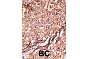 Formalin-fixed and paraffin-embedded human breast cancer tissue reacted with BAIAP2 polyclonal antibody  , which was peroxidase-conjugated to the secondary antibody, followed by AEC staining. (BAIAP2 anticorps  (C-Term))
