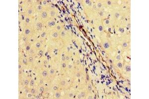 Immunohistochemistry of paraffin-embedded human liver cancer using ABIN7174393 at dilution of 1:100