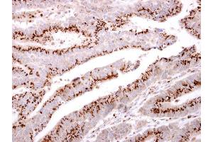 IHC-P Image GOLPH2 antibody [C3], C-term detects GOLPH2 protein at cytosol on human colon carcinoma by immunohistochemical analysis.
