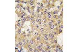 Formalin-fixed and paraffin-embedded human breast carcinoma tissue reacted with Parg antibody (C-term) , which was peroxidase-conjugated to the secondary antibody, followed by DAB staining. (PARG anticorps  (C-Term))