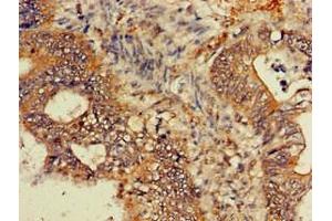 Immunohistochemistry of paraffin-embedded human colon cancer using ABIN7154741 at dilution of 1:100 (GNB4 anticorps  (AA 105-185))